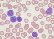 lymphocytic_leukemia