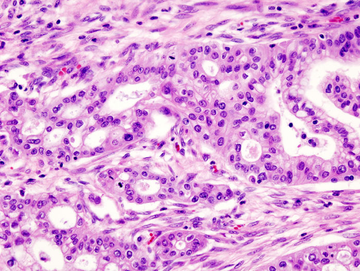 Pancreas adenocarcinoma