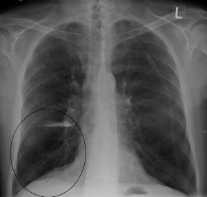 Aquinox COPD