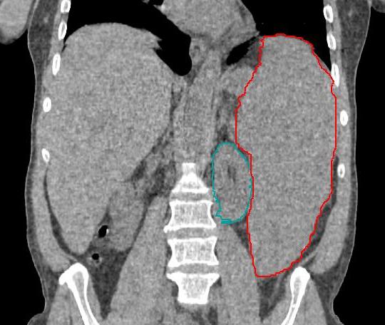 Tumor Myelodysplastic Spleen