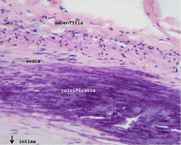 atherosclerotic plaque 