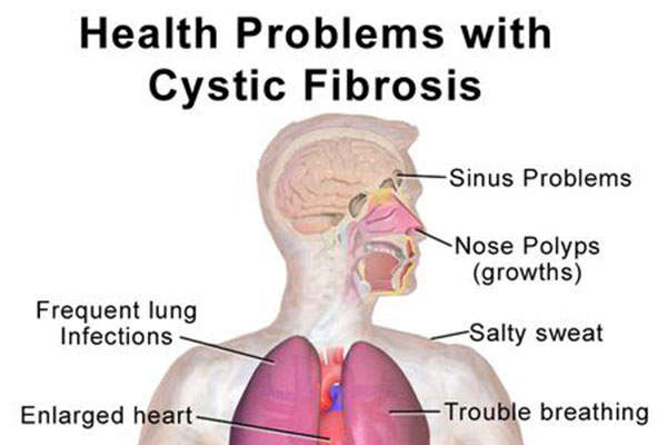 Image result for Cystic fibrosis