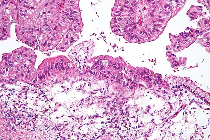 Mucinous lmp ovarian tumour intermed mag