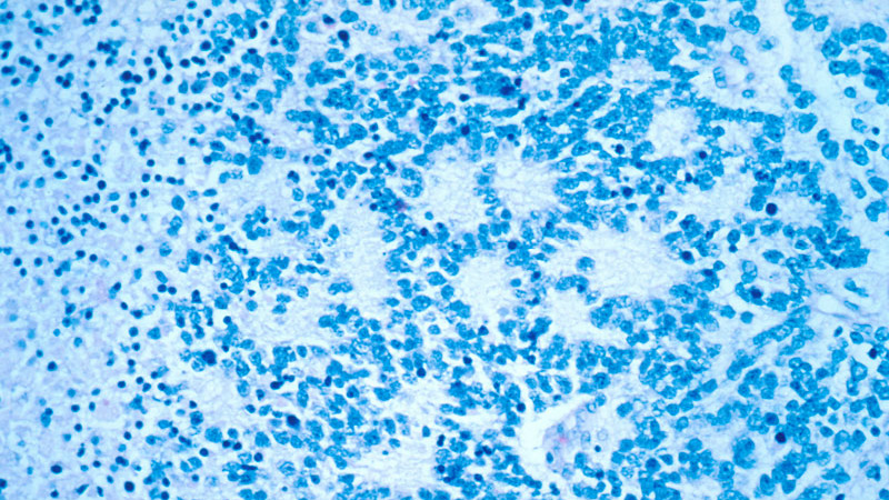 Anti-GD2 monoclonal antibody for treatment of neuroblastoma