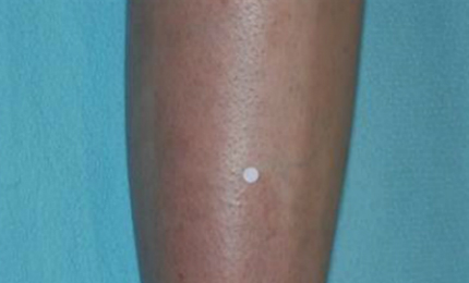 Image showing psoriasis on the leg of a patient in a Phase II trial for secukinumab in week ten.