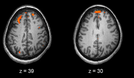 Schizophrenia brain scan