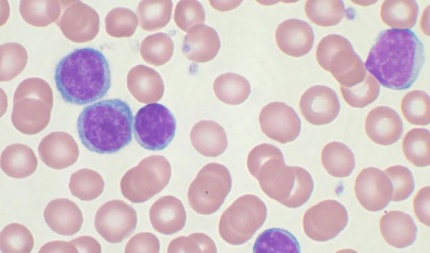 Chronic Lymphocytic Leukemia (CLL) is a white blood cells cancer that affects B-cell lymphocytes.