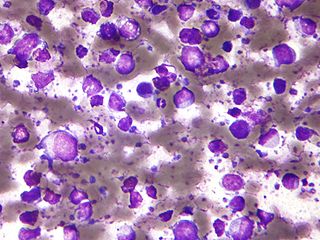 Large_b_cell_lymphoma