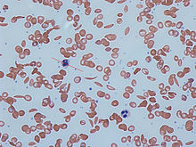 sickle cell anaemia
