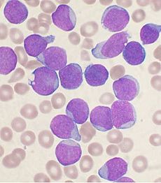 B-cell acute lymphoblastic leukemia