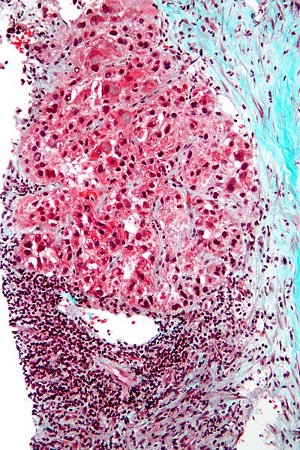 hepatocellular carcinoma 